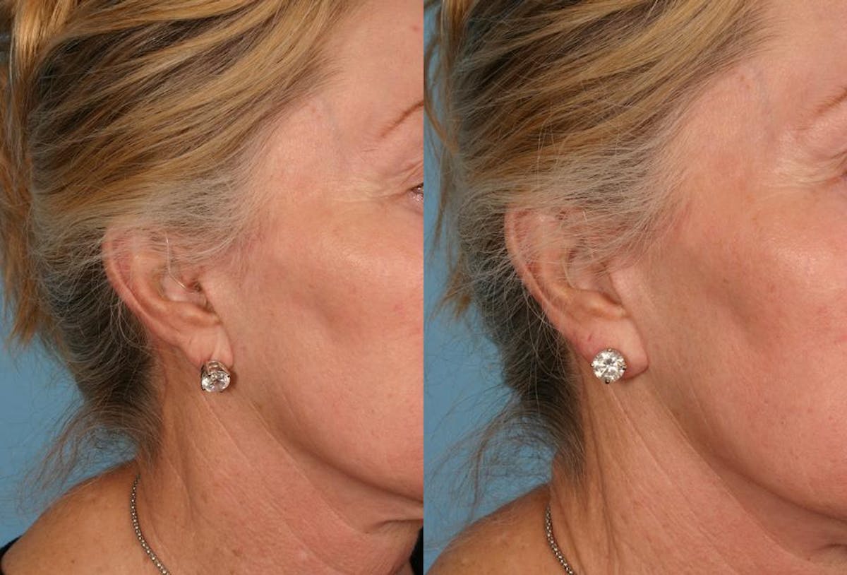 Restylane Before & After Gallery - Patient 328348 - Image 1