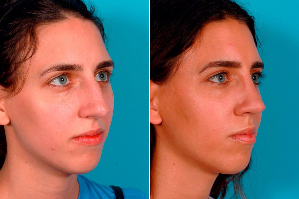 Rhinoplasty Before & After Gallery - Patient 180970 - Image 2
