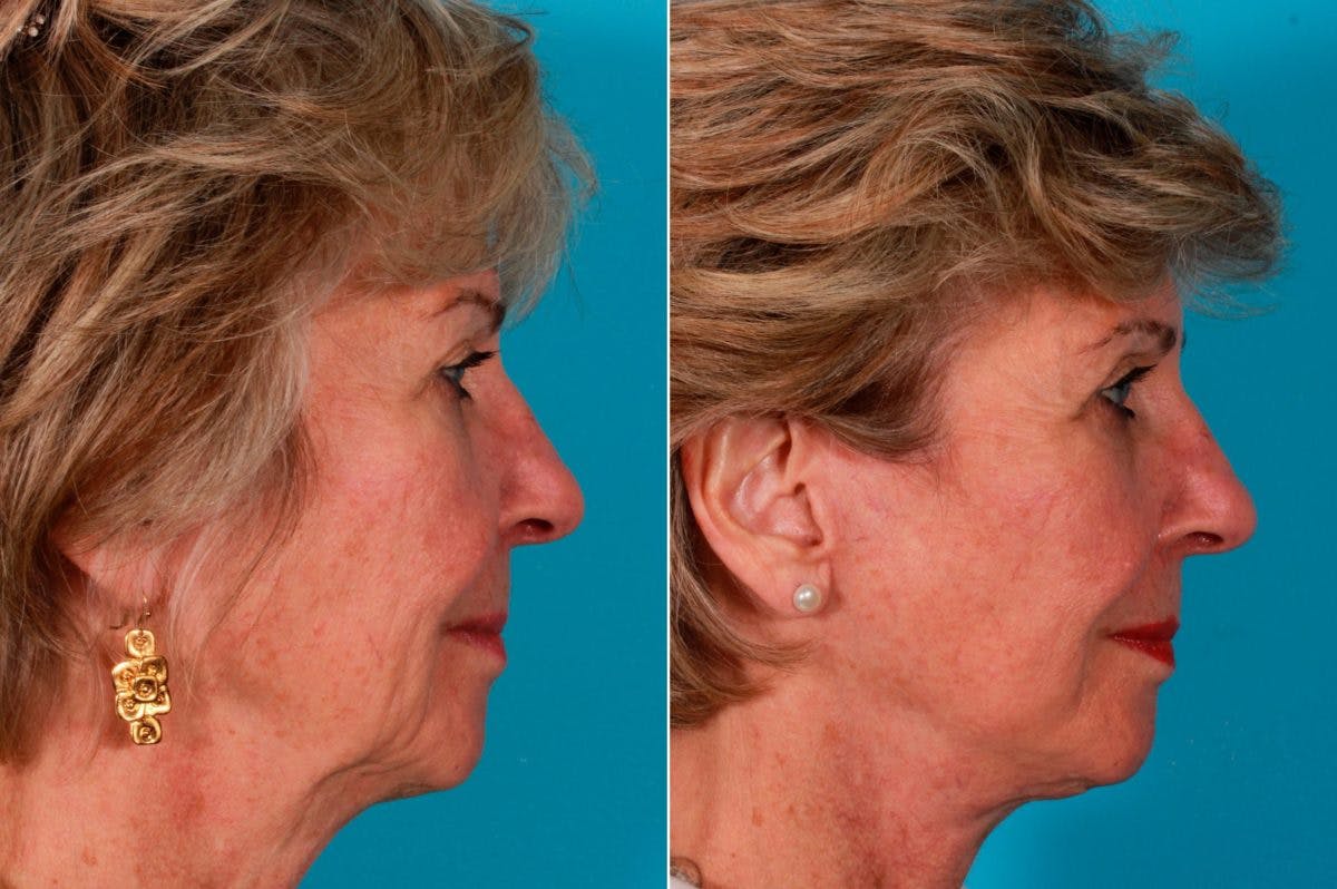 Facelift Before & After Gallery - Patient 181736 - Image 2