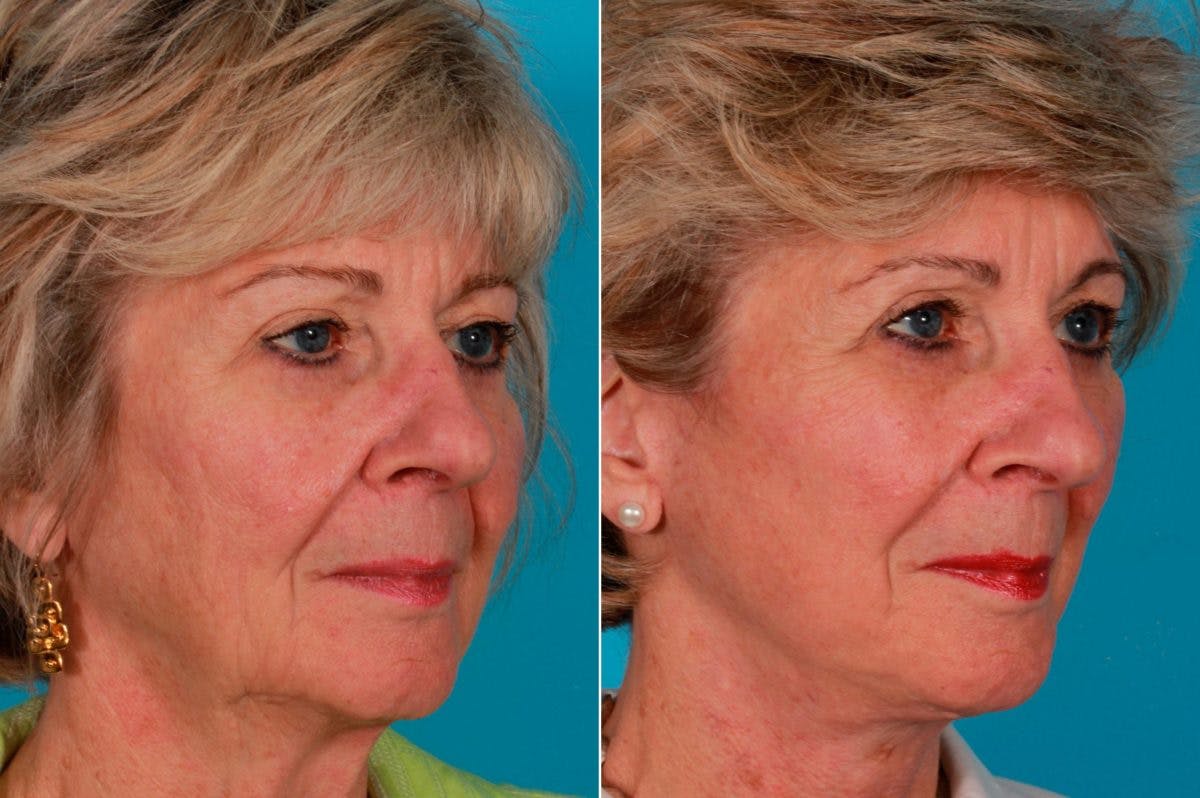 Facelift Before & After Gallery - Patient 181736 - Image 3