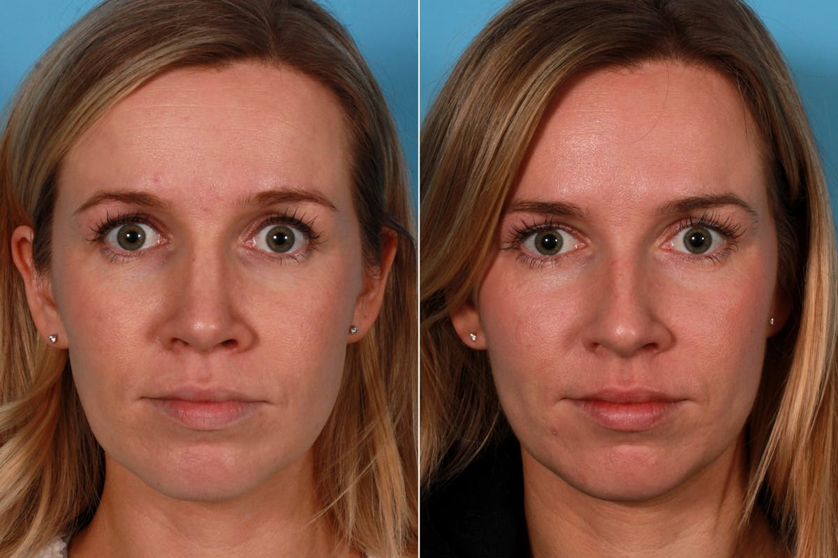 Rhinoplasty Before & After Gallery - Patient 937377 - Image 1