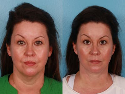 Facelift Before & After Gallery - Patient 337677 - Image 1