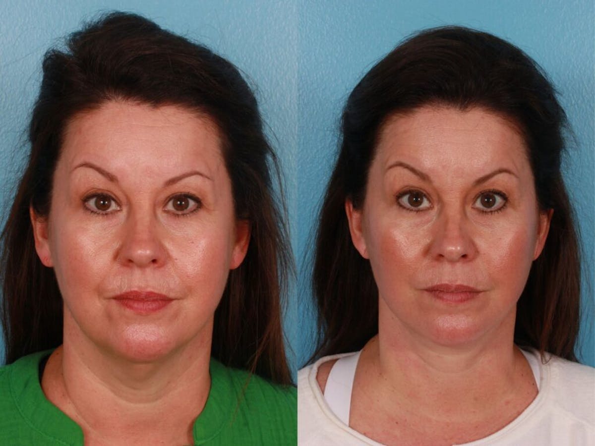 Facelift Before & After Gallery - Patient 337677 - Image 1