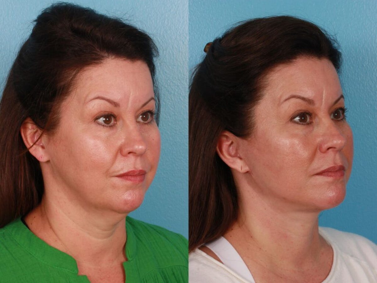 Facelift Before & After Gallery - Patient 337677 - Image 2