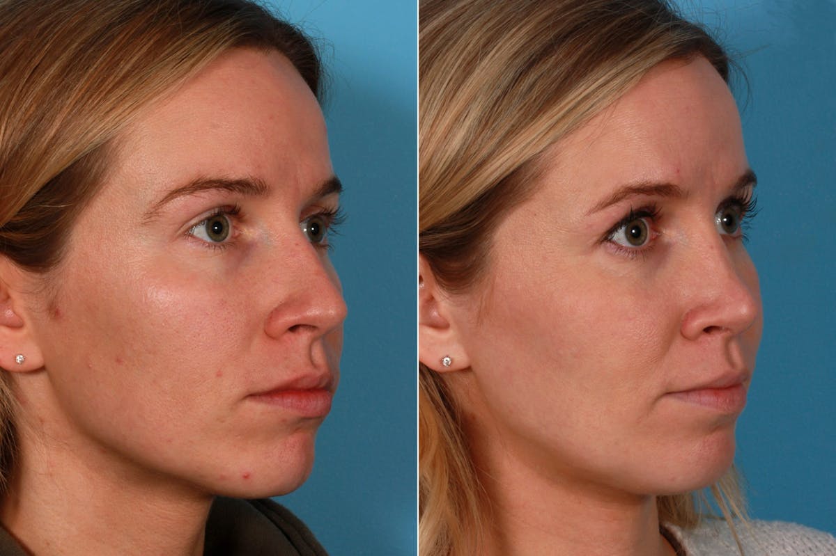 Rhinoplasty Before & After Gallery - Patient 937377 - Image 2