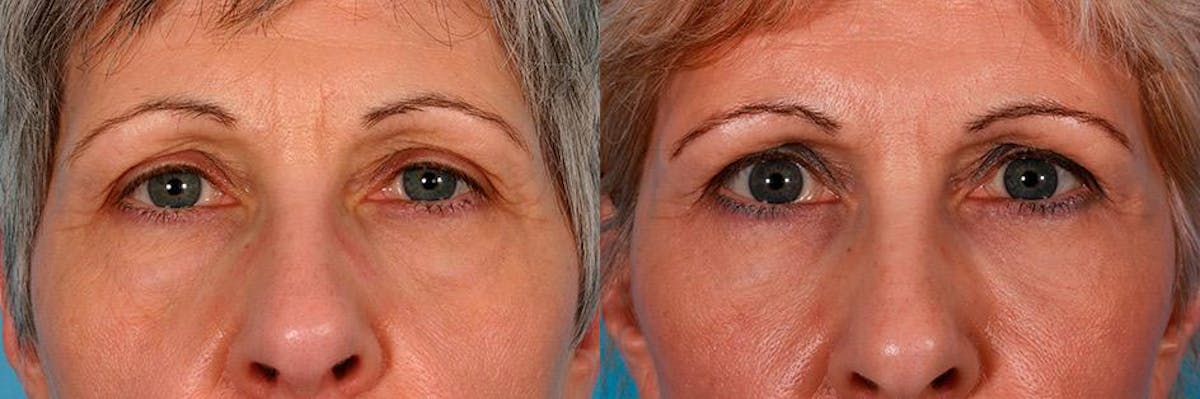 Eyelid Surgery (Blepharoplasty) Before & After Gallery - Patient 196256 - Image 4