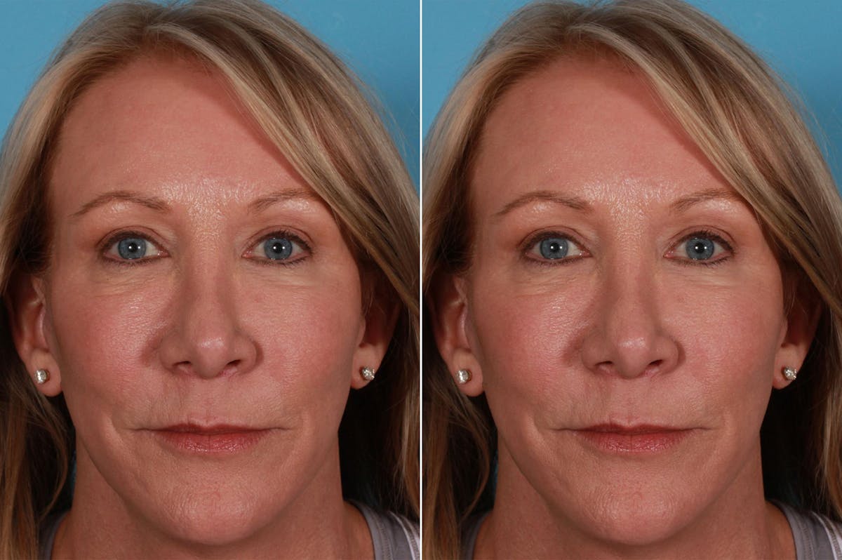 TCA Peel / Dermabrasion Before & After Gallery - Patient 730576 - Image 5