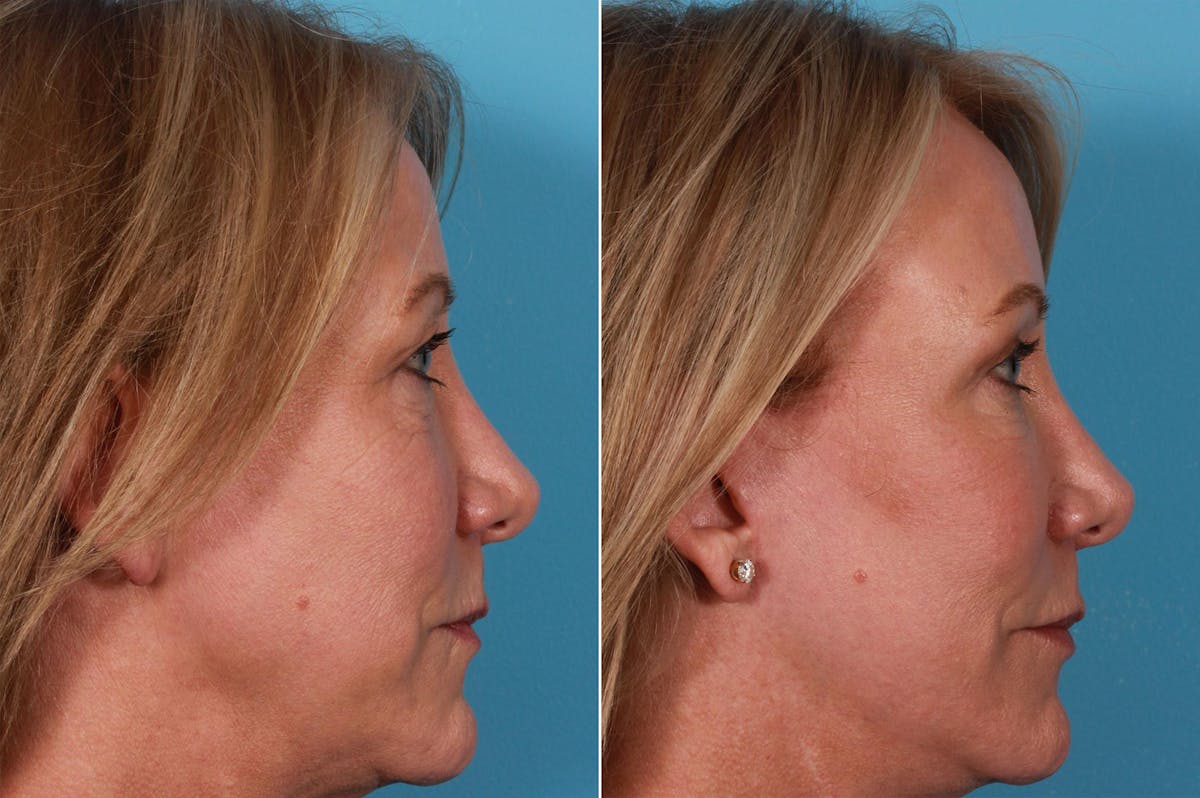 TCA Peel / Dermabrasion Before & After Gallery - Patient 730576 - Image 6