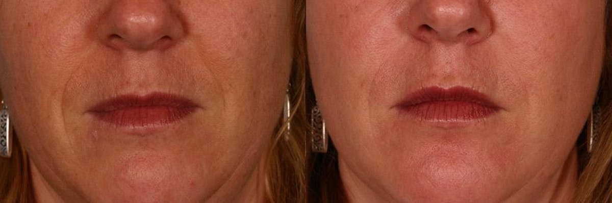 Restylane Before & After Gallery - Patient 136556 - Image 1