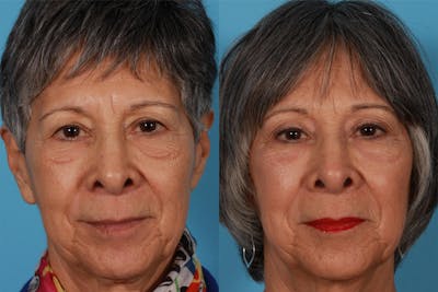 Eyelid Surgery (Blepharoplasty) Before & After Gallery - Patient 130328 - Image 1