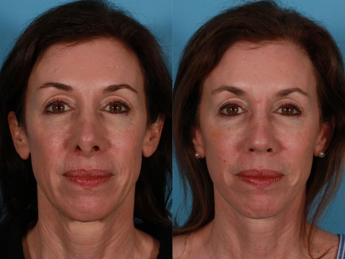 Facial Fat Transfer Before & After Gallery - Patient 426963 - Image 1