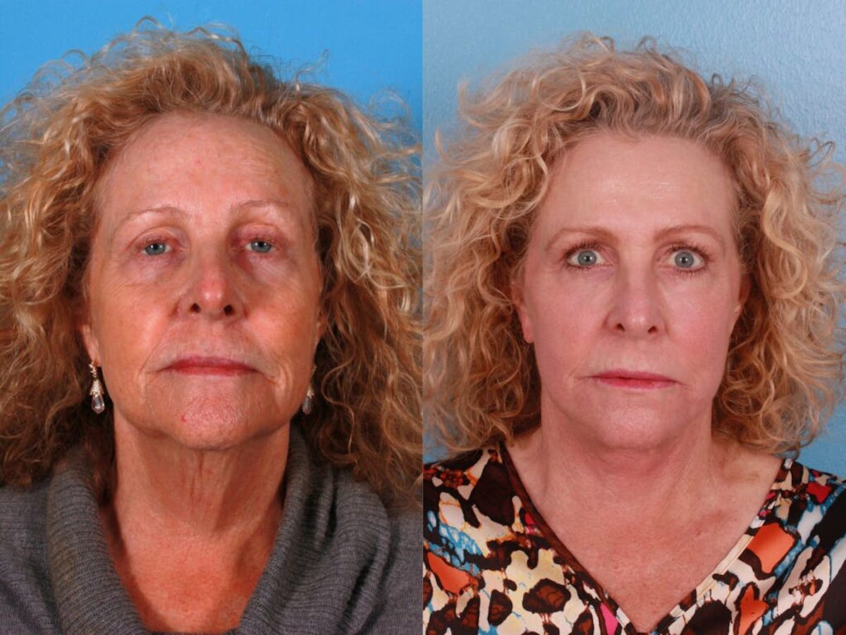Facelift Before & After Gallery - Patient 243413 - Image 1