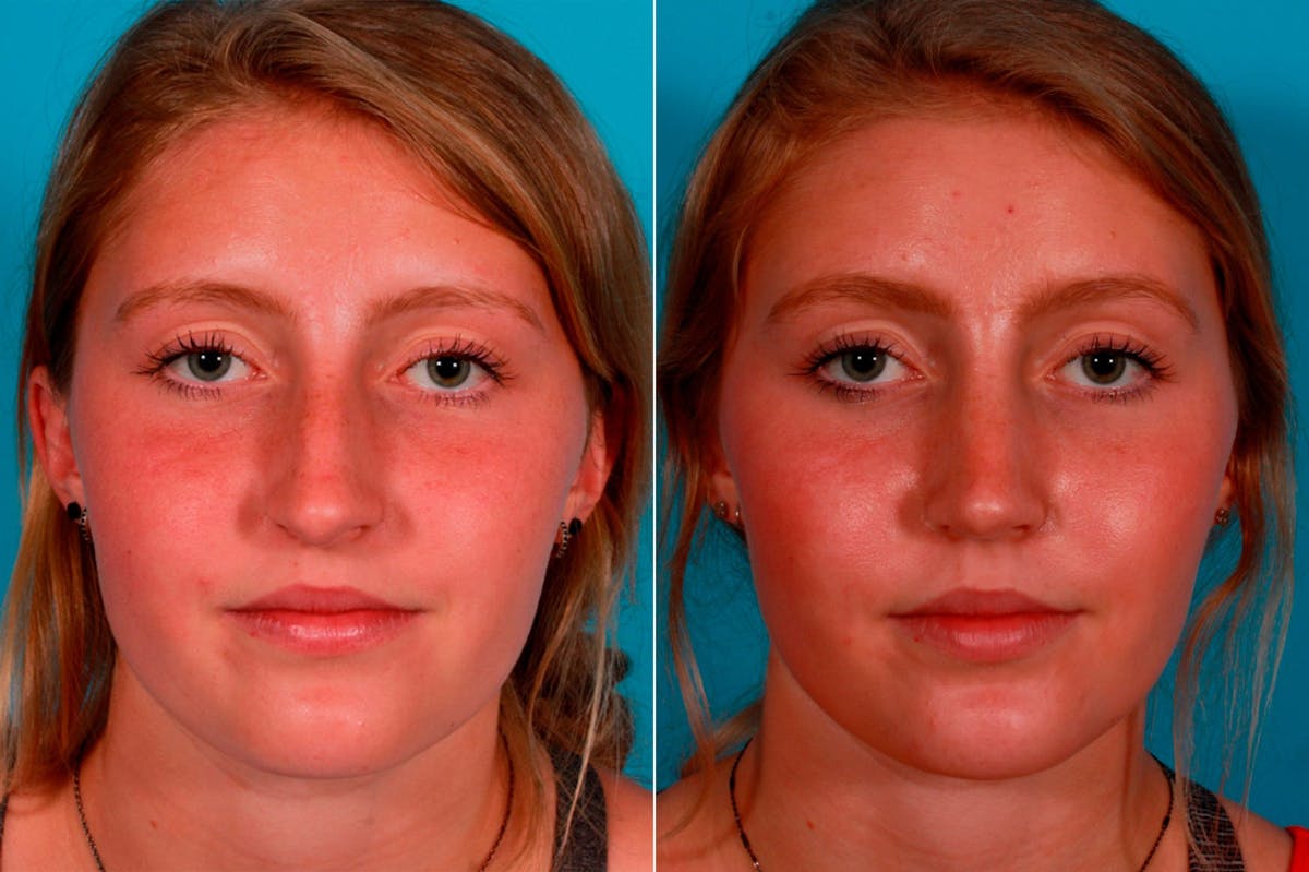 Rhinoplasty Before & After Gallery - Patient 231749 - Image 1