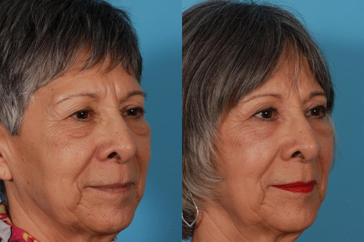 Eyelid Surgery (Blepharoplasty) Before & After Gallery - Patient 130328 - Image 2
