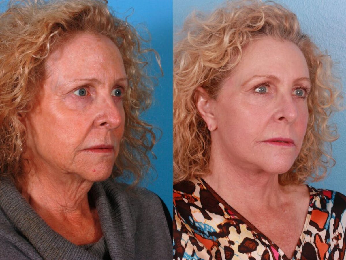 Facelift Before & After Gallery - Patient 243413 - Image 2