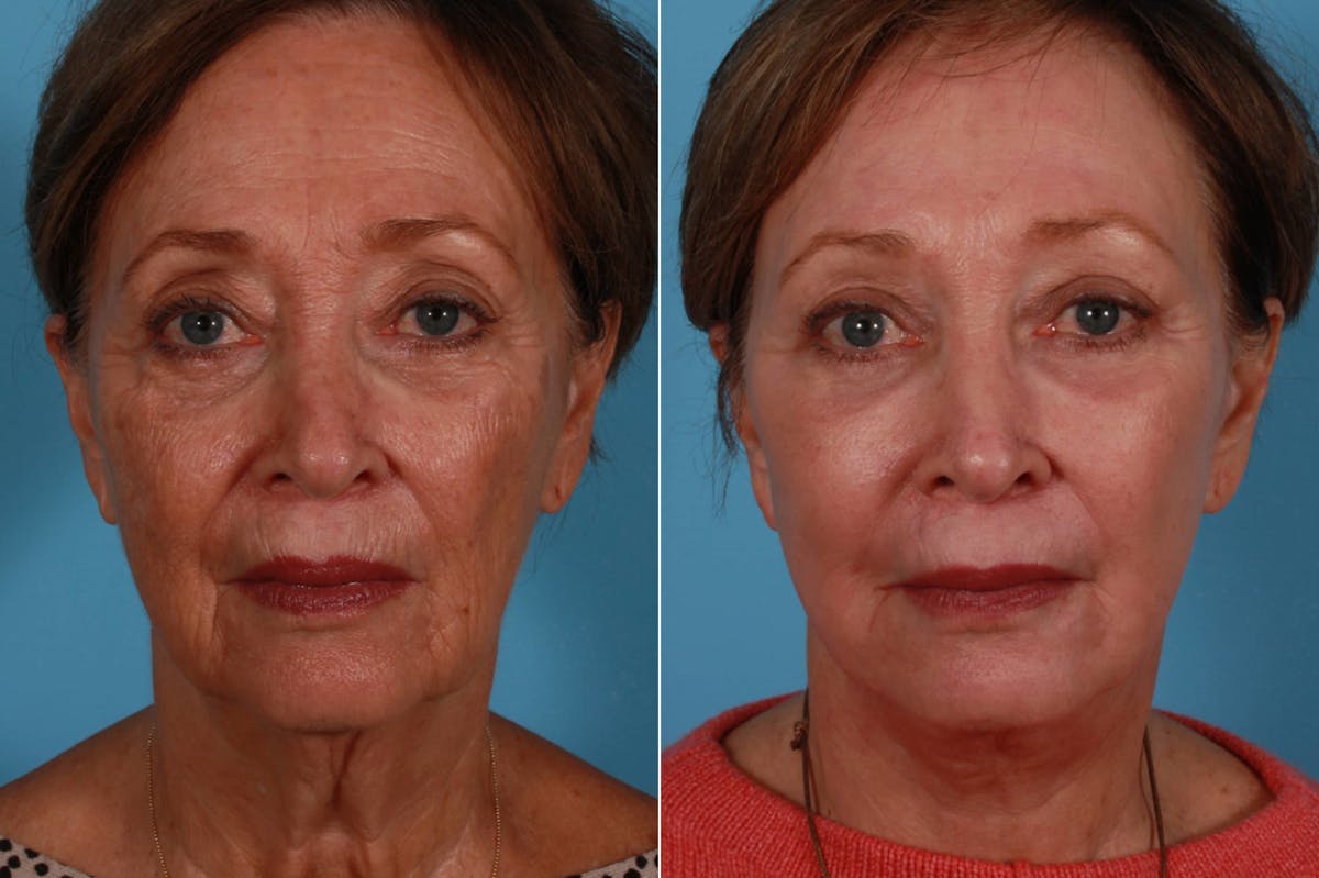 TCA Peel / Dermabrasion Before & After Gallery - Patient 362779 - Image 1