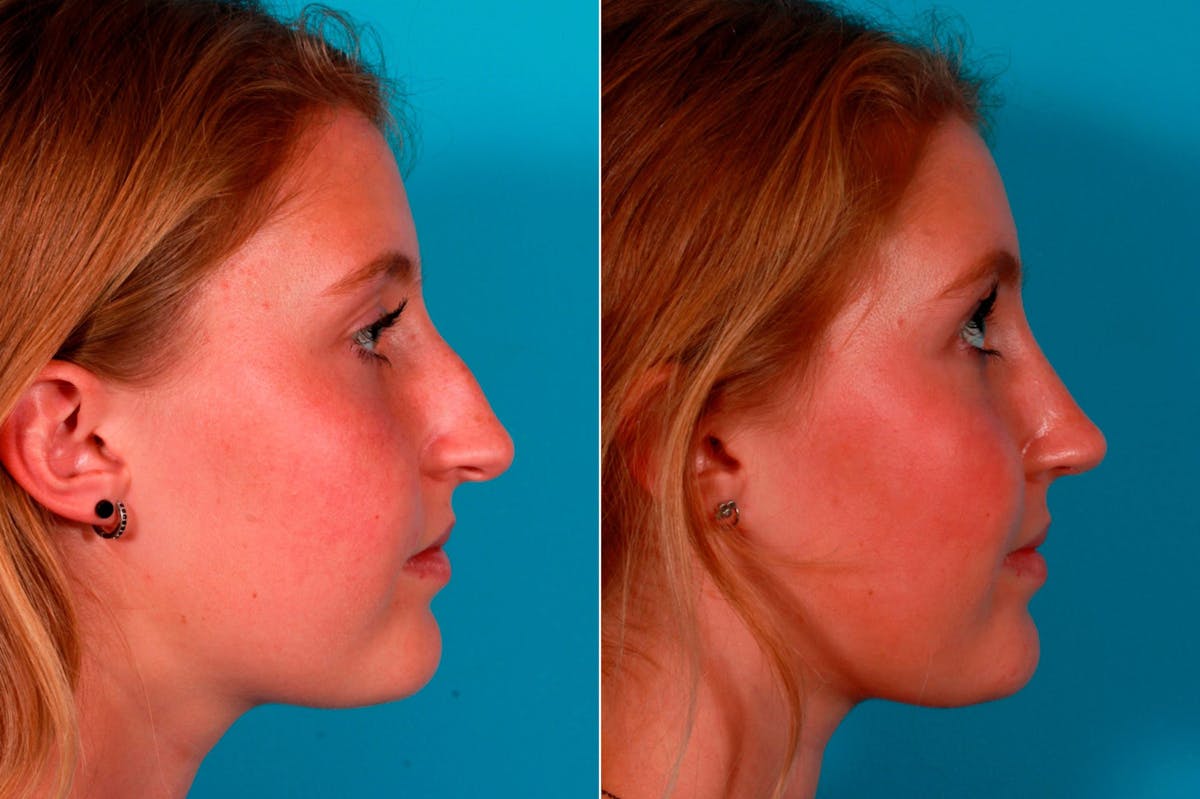 Rhinoplasty Before & After Gallery - Patient 231749 - Image 2