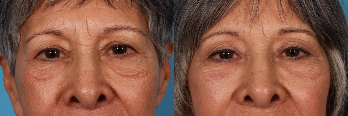 Eyelid Surgery (Blepharoplasty) Before & After Gallery - Patient 130328 - Image 3
