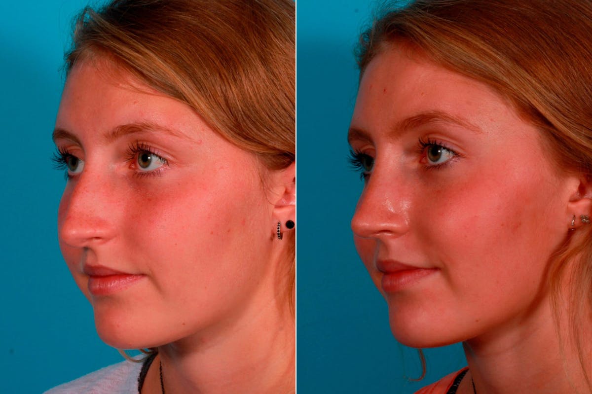 Rhinoplasty Before & After Gallery - Patient 231749 - Image 3