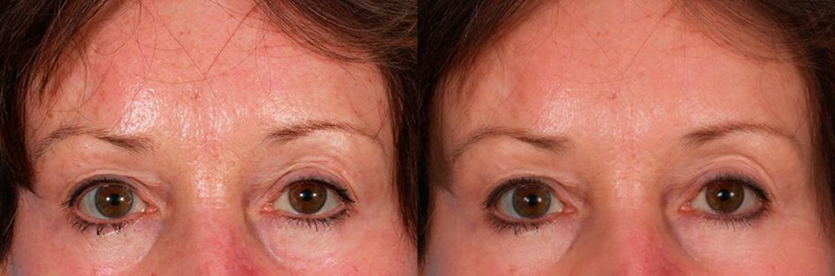 Restylane Before & After Gallery - Patient 299285 - Image 1