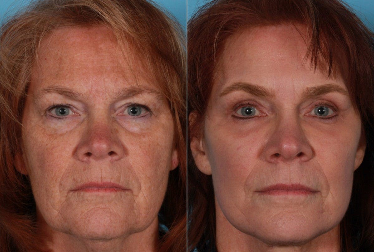 TCA Peel / Dermabrasion Before & After Gallery - Patient 958769 - Image 1