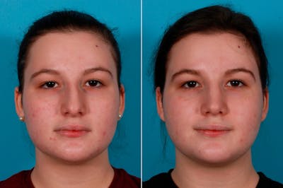 Rhinoplasty Before & After Gallery - Patient 114333 - Image 1