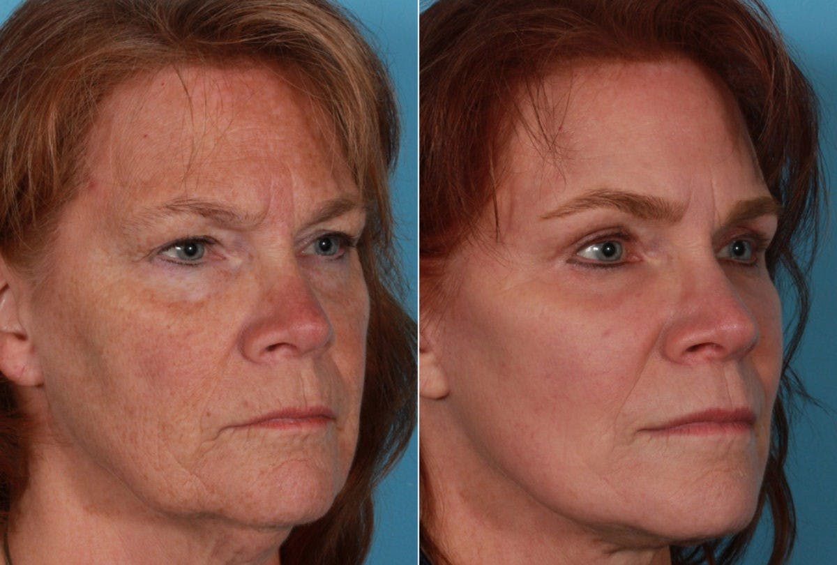 TCA Peel / Dermabrasion Before & After Gallery - Patient 958769 - Image 2