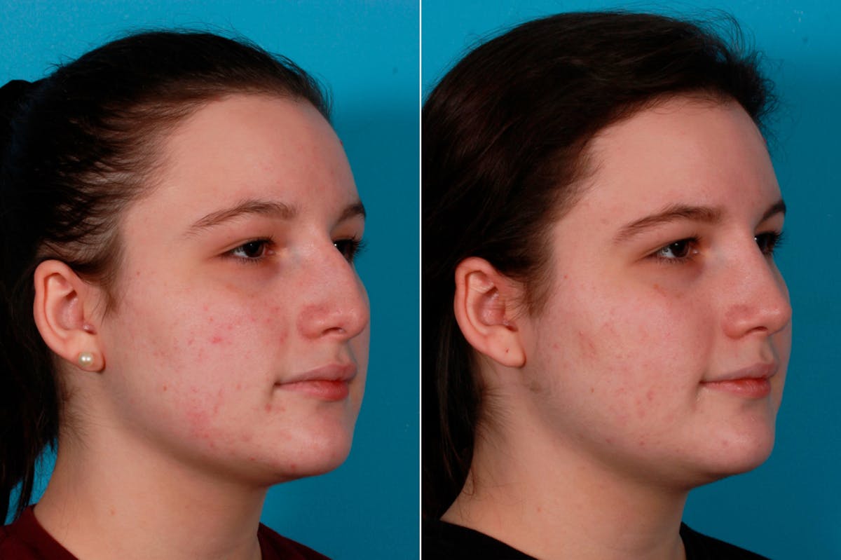 Rhinoplasty Before & After Gallery - Patient 114333 - Image 2