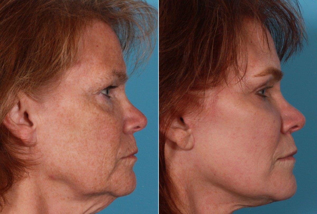 TCA Peel / Dermabrasion Before & After Gallery - Patient 958769 - Image 3