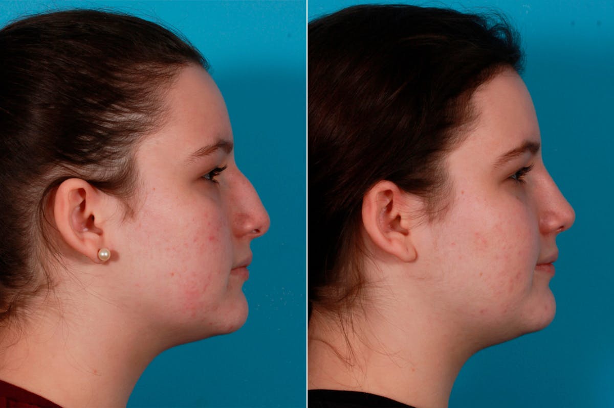 Rhinoplasty Before & After Gallery - Patient 114333 - Image 3