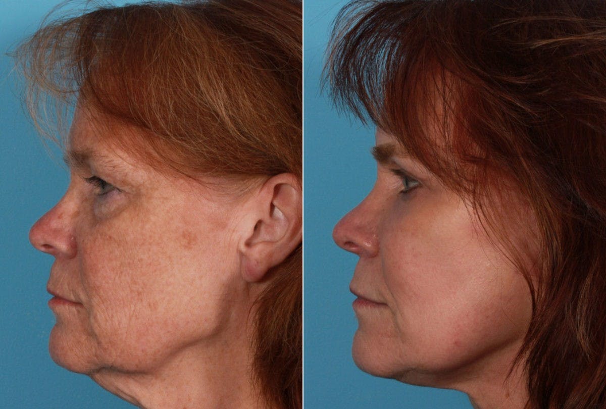 TCA Peel / Dermabrasion Before & After Gallery - Patient 958769 - Image 4