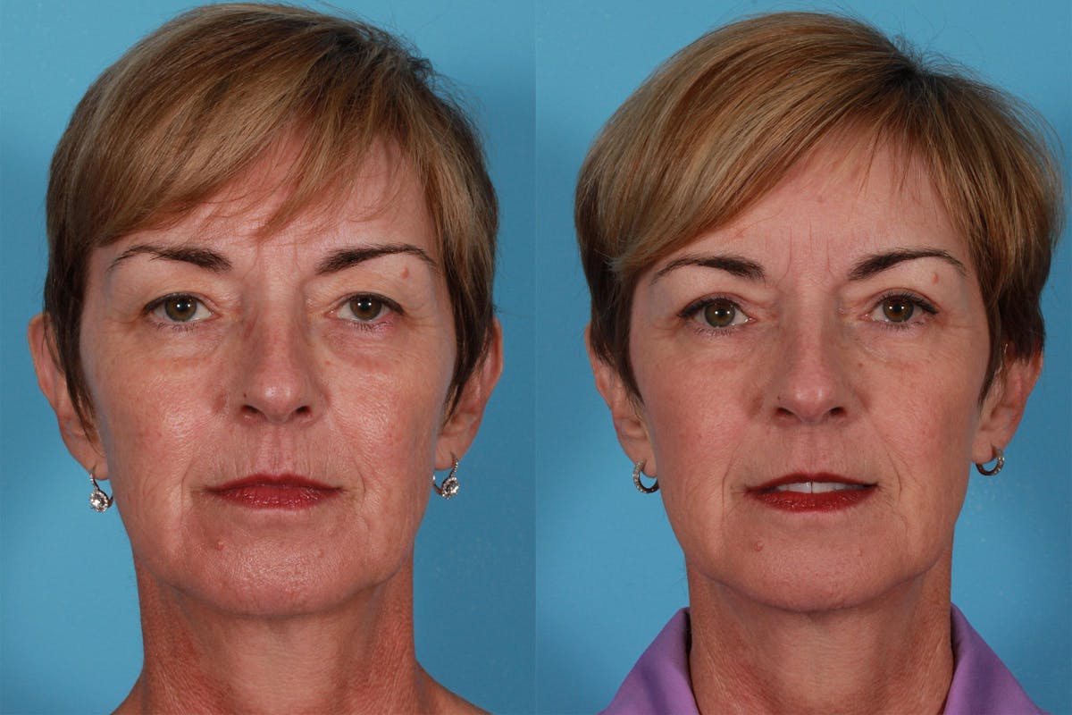 Eyelid Surgery (Blepharoplasty) Before & After Gallery - Patient 152886 - Image 1