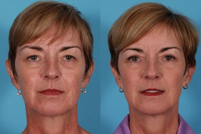 Eyelid Surgery (Blepharoplasty) Before & After Gallery - Patient 152886 - Image 1
