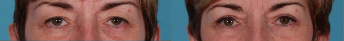 Eyelid Surgery (Blepharoplasty) Before & After Gallery - Patient 152886 - Image 2