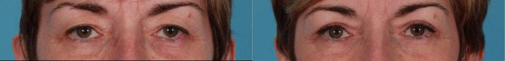 Eyelid Surgery (Blepharoplasty) Before & After Gallery - Patient 152886 - Image 2
