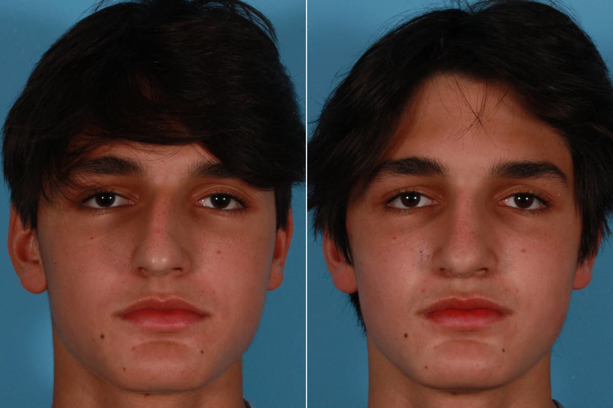Rhinoplasty Before & After Gallery - Patient 376565 - Image 1