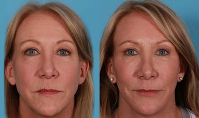 Eyelid Surgery (Blepharoplasty) Before & After Gallery - Patient 169878 - Image 1