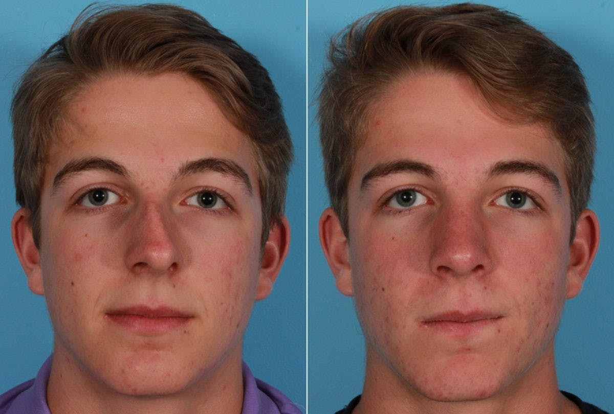 Rhinoplasty Before & After Gallery - Patient 273172 - Image 1