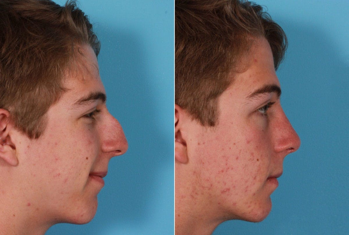 Rhinoplasty Before & After Gallery - Patient 273172 - Image 2