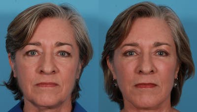 Eyelid Surgery (Blepharoplasty) Before & After Gallery - Patient 279585 - Image 1