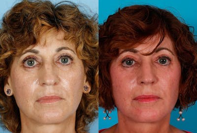 Rhinoplasty Before & After Gallery - Patient 177546 - Image 1