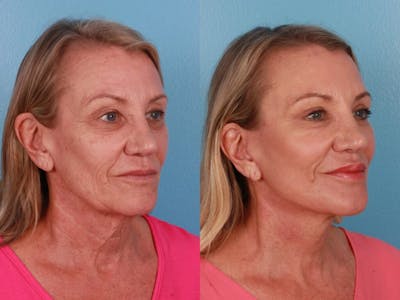 TCA Peel / Dermabrasion Before & After Gallery - Patient 217969 - Image 1