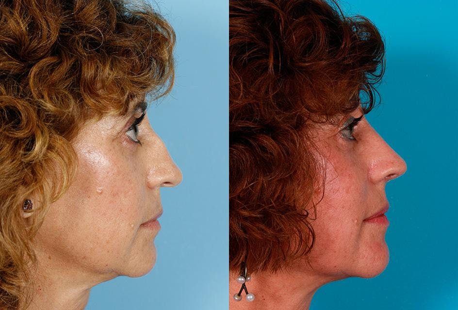Rhinoplasty Before & After Gallery - Patient 177546 - Image 2