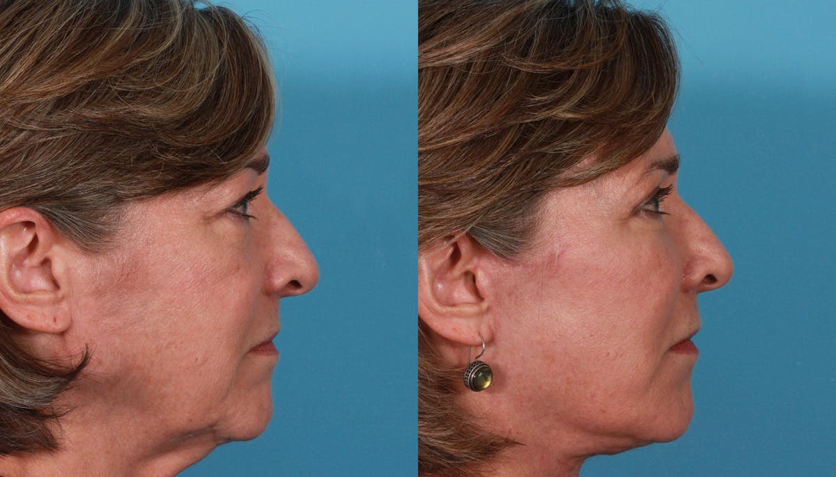 Eyelid Surgery (Blepharoplasty) Before & After Gallery - Patient 279585 - Image 4