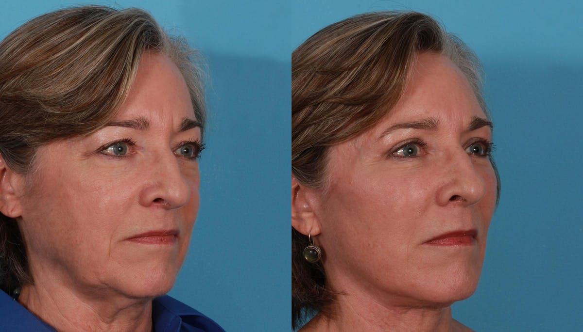 Eyelid Surgery (Blepharoplasty) Before & After Gallery - Patient 279585 - Image 5
