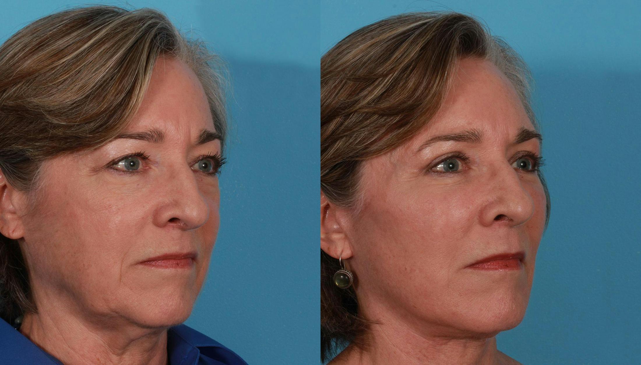 Eyelid Surgery (Blepharoplasty) Before & After Gallery - Patient 279585 - Image 3