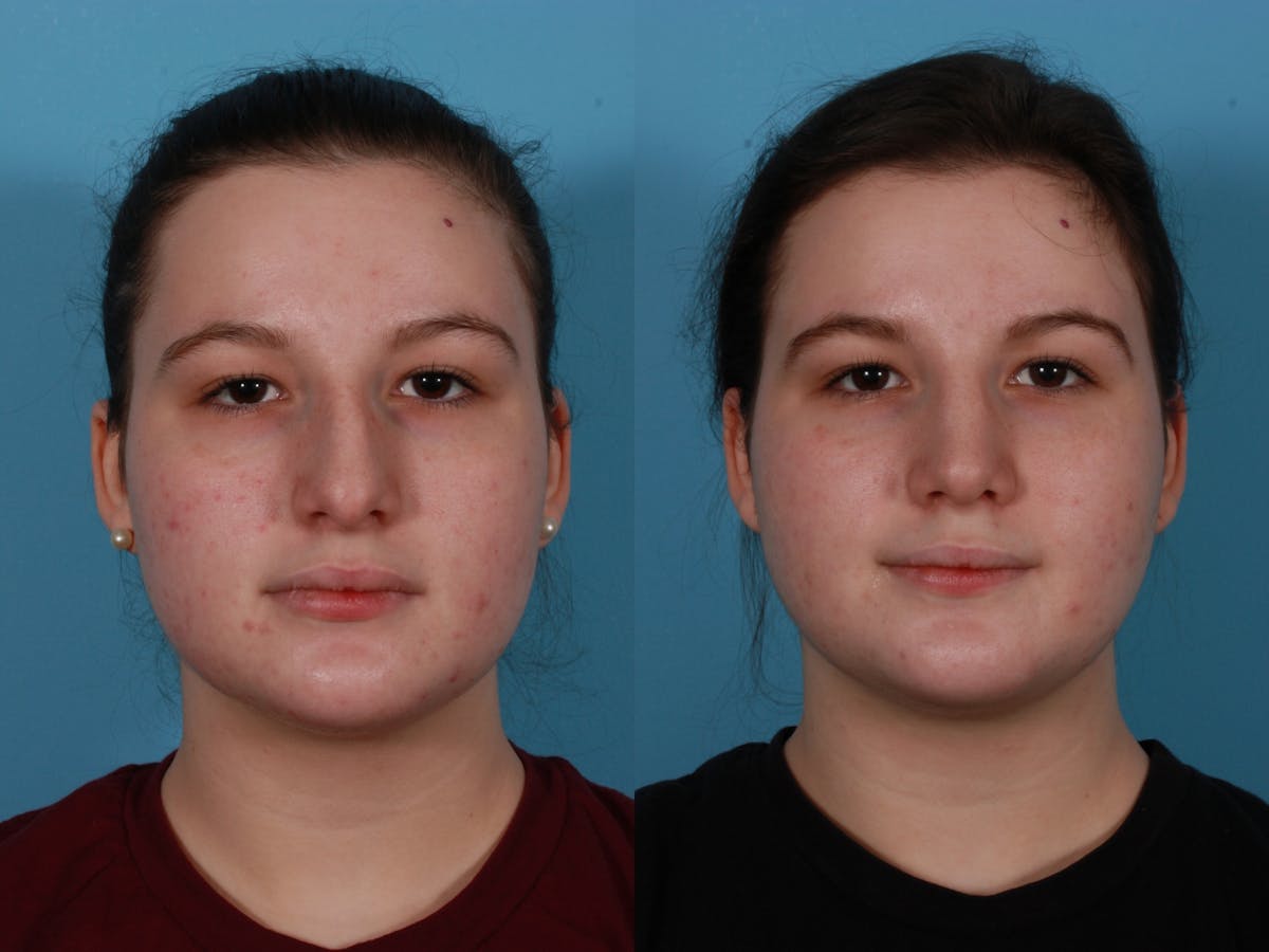 Rhinoplasty Before & After Gallery - Patient 362332 - Image 1
