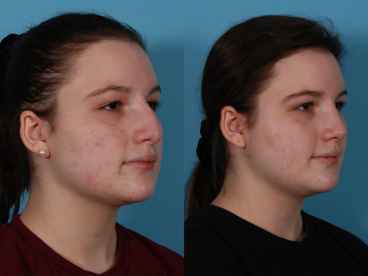 Rhinoplasty Before & After Gallery - Patient 362332 - Image 2