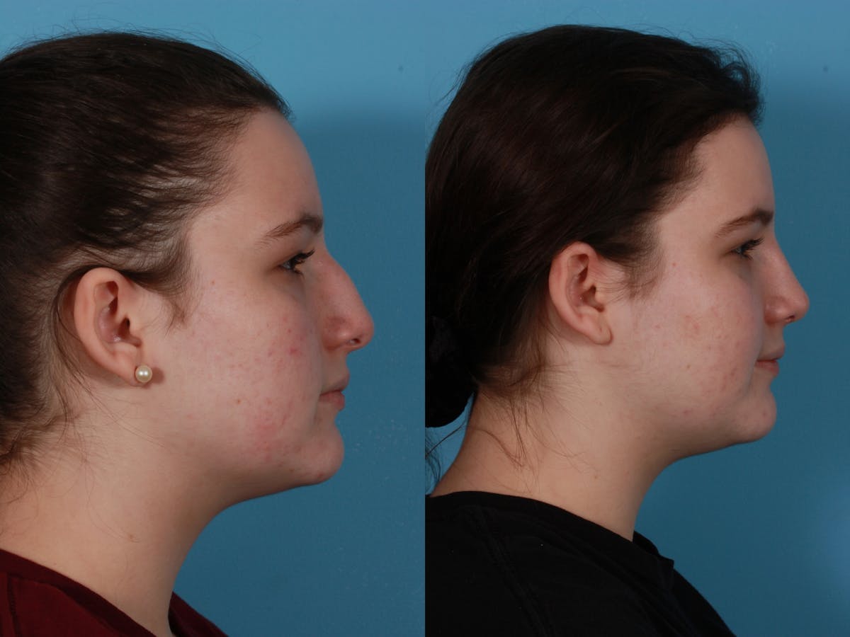 Rhinoplasty Before & After Gallery - Patient 362332 - Image 3