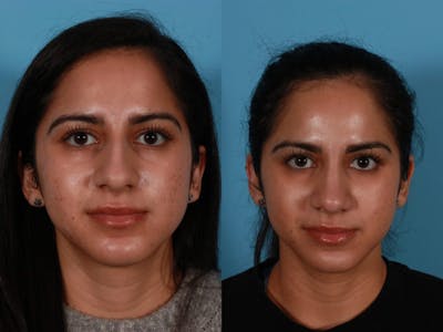 Rhinoplasty Before & After Gallery - Patient 322654 - Image 1